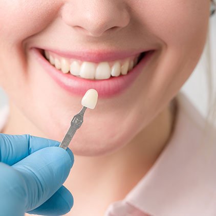 New Haven Dental Veneers